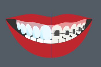 Grafik zeigt den Vergleich von den Zahnspangen Systemen Invisalign und Brackets